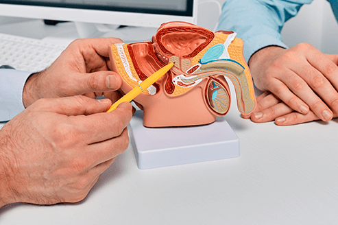 Etapas cancer prostata